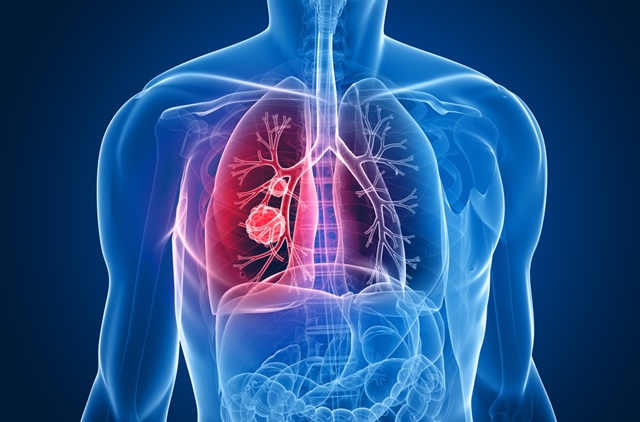 Cancerul pulmonar - Tratament si simptome timpurii, cancer la plamani