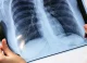 Săptămâna trecută, în capitală au fost înregistrate 14 cazuri de tuberculoză
