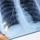 Săptămâna trecută, în capitală au fost înregistrate 14 cazuri de tuberculoză