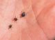 Atenție la căpușe! ANSP a raportat 159 de cazuri de boală Lyme în anul trecut
