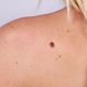 Date oficiale: 1 246 de cazuri de cancer non-melanom au fost înregistrate în Republica Moldova în 2025