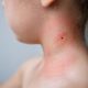 Boala Lyme, principalul pericol transmis de căpușe în Republica Moldova. Recomandările autorităților pentru prevenirea infectării